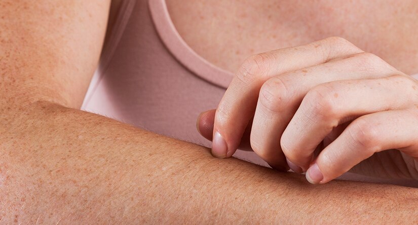 Sådan tager du hånd om kløende hud: Årsager, behandling og råd om forebyggelse Sådan tager du hånd om kløende hud: Årsager, behandling og råd om forebyggelse